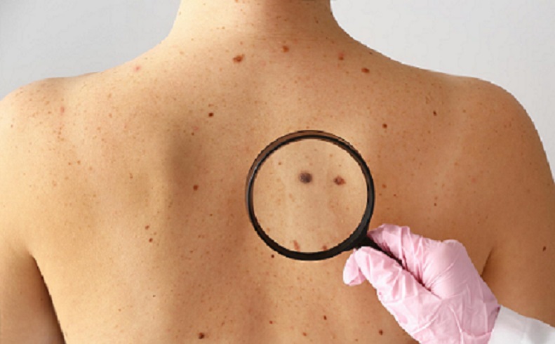 Skin cancer project